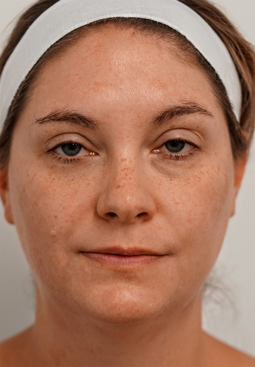 BBL HEROic · Face example 1: before, photograph published by Sciton