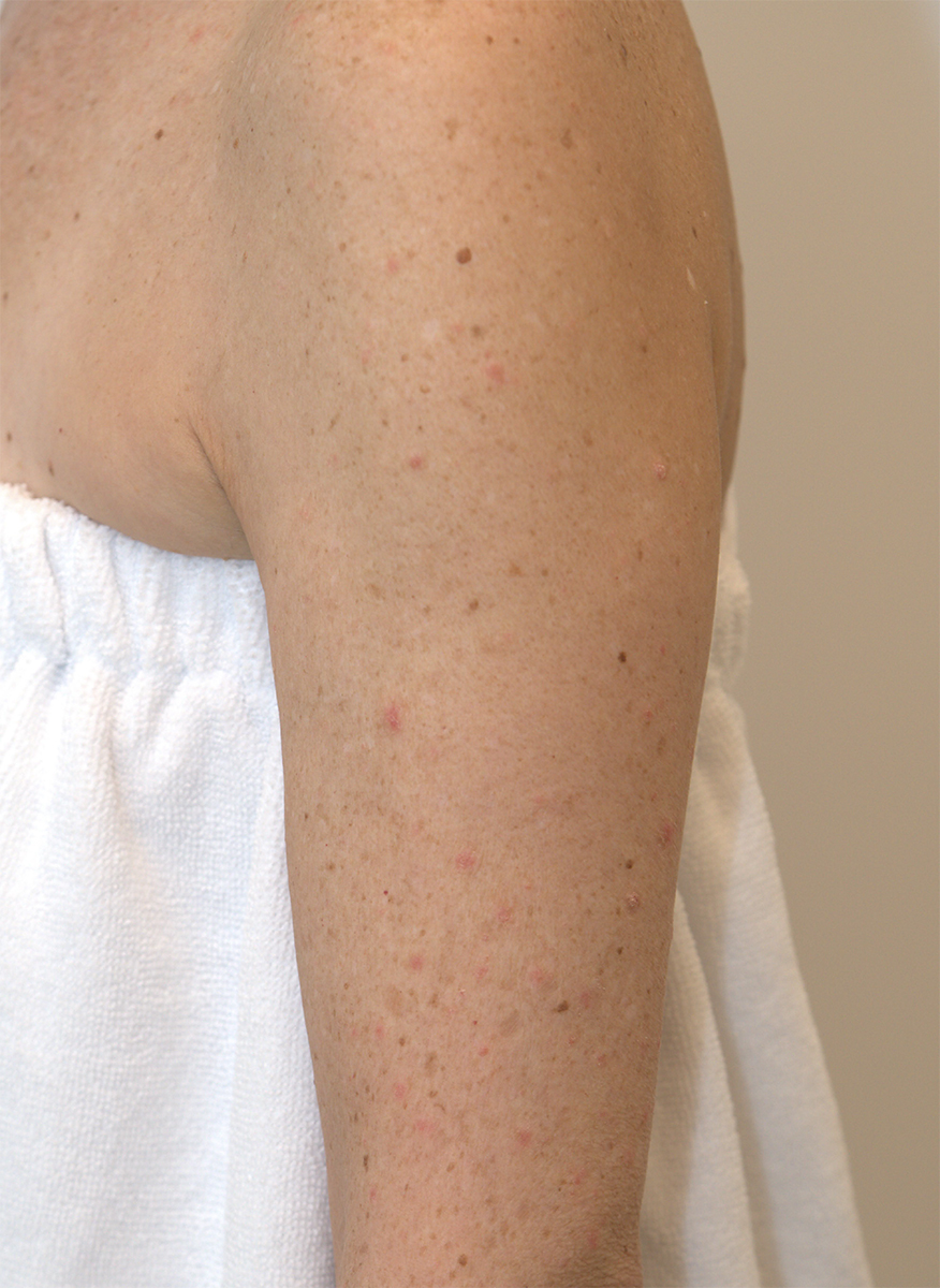 BBL HEROic · Arm example, before: manufacturer photograph